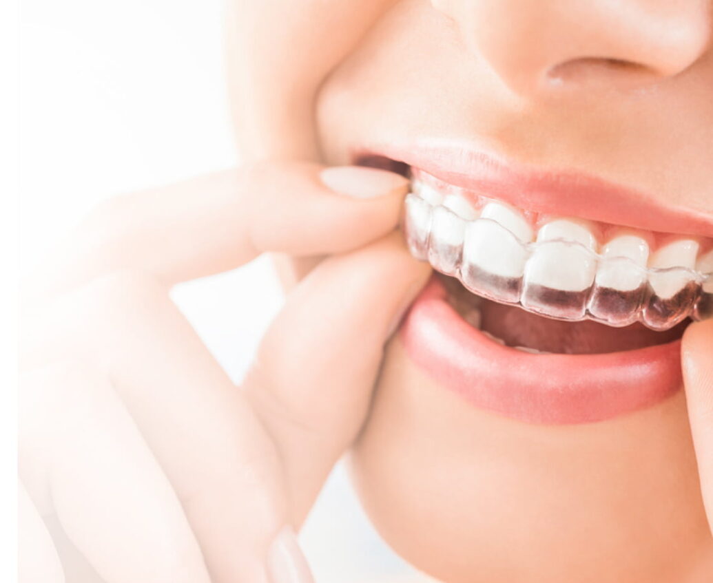 Invisalign