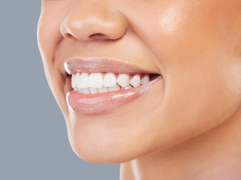 Porcelain Veneers