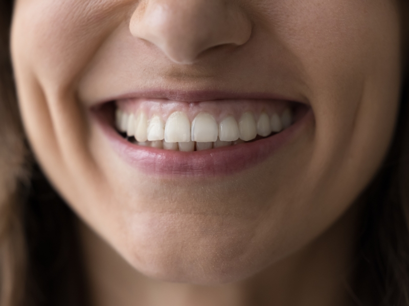 Gummy smiles