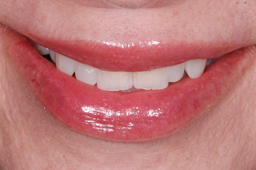 Composite veneers - Case 7 before