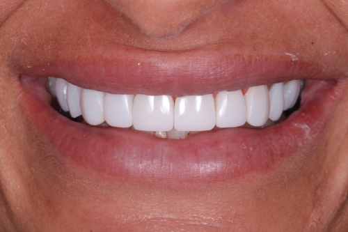 Composite veneers - Case 8 after