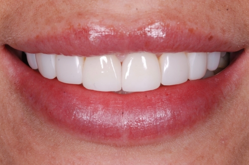 Crowns - Case 1 after