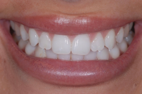 Edge bonding - Case 1 before