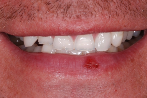 Edge bonding - Case 6 before