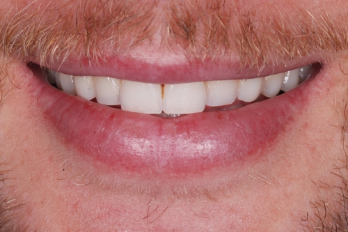 Invisalign rejuvenate package - Case 1 before