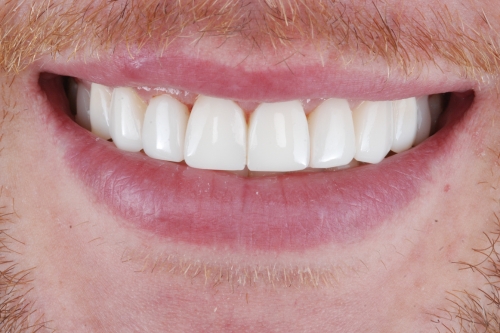 Invisalign rejuvenate package - Case 1 after