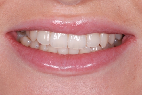 Invisalign enhance package - Case 1 before
