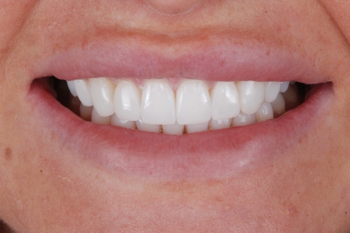 Invisalign enhance package - Case 3 after